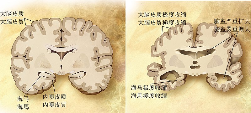 800px-Alzheimer's_disease_brain_comparison-zh.jpg